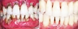 Esthetic Periodontal Crown new