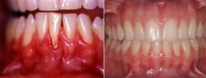 Gingival Recession New