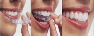 Invisalign new