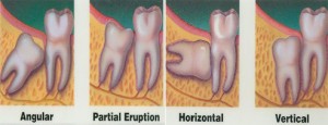 Wisdom Tooth Removal2